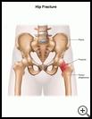 Thumbnail image of: Hip Fracture: Illustration