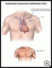 Thumbnail image of: Implantable Cardioverter Defibrillator (ICD): Illustration