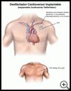 Thumbnail image of: Implantable Cardioverter Defibrillator (ICD)