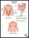 Thumbnail image of: Ileostomy: Illustration