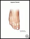 Thumbnail image of: Ingrown Toenail: Illustration
