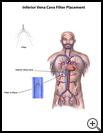 Thumbnail image of: Inferior Vena Cava Filter Placement: Illustration