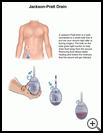 Thumbnail image of: Jackson-Pratt Drain: Illustration