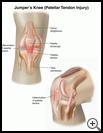 Thumbnail image of: Jumper's Knee (Patellar Tendon Injury): Illustration