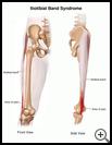 Thumbnail image of: Iliotibial Band Syndrome: Illustration