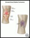 Thumbnail image of: Bruised Knee (Patellar Contusion): Illustration