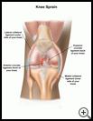 Thumbnail image of: Knee Sprain: Illustration