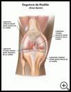 Thumbnail image of: Knee Sprain: Illustration