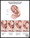 Thumbnail image of: Cervical Effacement and Dilation During Labor: Illustration