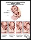 Thumbnail image of: Cervical Effacement and Dilation During Labor: Illustration