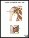 Thumbnail image of: Shoulder Cartilage Tear (Labral Tear): Illustration