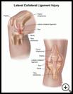 Thumbnail image of: Lateral Collateral Ligament Injury: Illustration