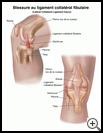 Thumbnail image of: Lateral Collateral Ligament Injury: Illustration