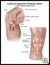 Thumbnail image of: Lateral Collateral Ligament Injury: Illustration