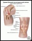 Thumbnail image of: Lateral Collateral Ligament Injury: Illustration