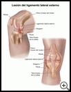 Thumbnail image of: Lateral Collateral Ligament Injury: Illustration