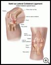 Thumbnail image of: Lateral Collateral Ligament Injury: Illustration