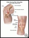Thumbnail image of: Lateral Collateral Ligament Injury: Illustration