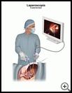Thumbnail image of: Laparoscopy: Illustration
