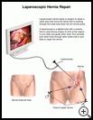 Thumbnail image of: Laparoscopic Hernia Repair: Illustration
