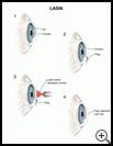 Thumbnail image of: LASIK: Illustration