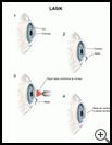 Thumbnail image of: LASIK: Illustration