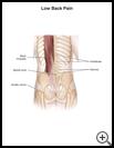 Thumbnail image of: Low Back Pain: Illustration