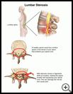 Thumbnail image of: Lumbar Stenosis: Illustration
