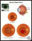 Thumbnail image of: Macular Degeneration: Illustration