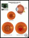 Thumbnail image of: Macular Degeneration: Illustration