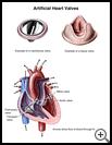 Thumbnail image of: Artificial Heart Valves: Illustration