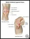 Thumbnail image of: Medial Collateral Ligament Injury: Illustration