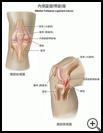 Thumbnail image of: Medial Collateral Ligament Tear: Illustration