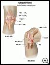 Thumbnail image of: Medial Collateral Ligament Tear: Illustration