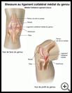 Thumbnail image of: Medial Collateral Ligament Tear: Illustration