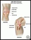 Thumbnail image of: Medial Collateral Ligament Tear: Illustration