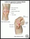 Thumbnail image of: Medial Collateral Ligament Tear: Illustration