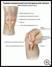 Thumbnail image of: Medial Collateral Ligament Tear: Illustration
