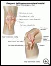 Thumbnail image of: Medial Collateral Ligament Tear: Illustration