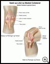 Thumbnail image of: Medial Collateral Ligament Tear: Illustration