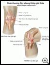 Thumbnail image of: Medial Collateral Ligament Tear: Illustration