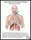 Thumbnail image of: Endoscopy of the Chest: Illustration