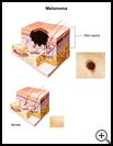 Thumbnail image of: Melanoma: Illustration