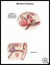 Thumbnail image of: Ménière’s Disease: Illustration