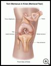 Thumbnail image of: Torn Meniscus in Knee (Meniscal Tear): Illustration