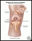 Thumbnail image of: Meniscal (Cartilage) Tear: Illustration