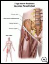 Thumbnail image of: Thigh Nerve Problems (Meralgia Paresthetica): Illustration