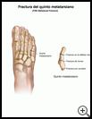 Thumbnail image of: Foot Fracture, Fifth Metatarsal Fracture: Illustration