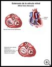 Thumbnail image of: Mitral Valve Stenosis: Illustration