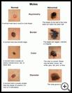 Thumbnail image of: Moles (ABCD): Illustration